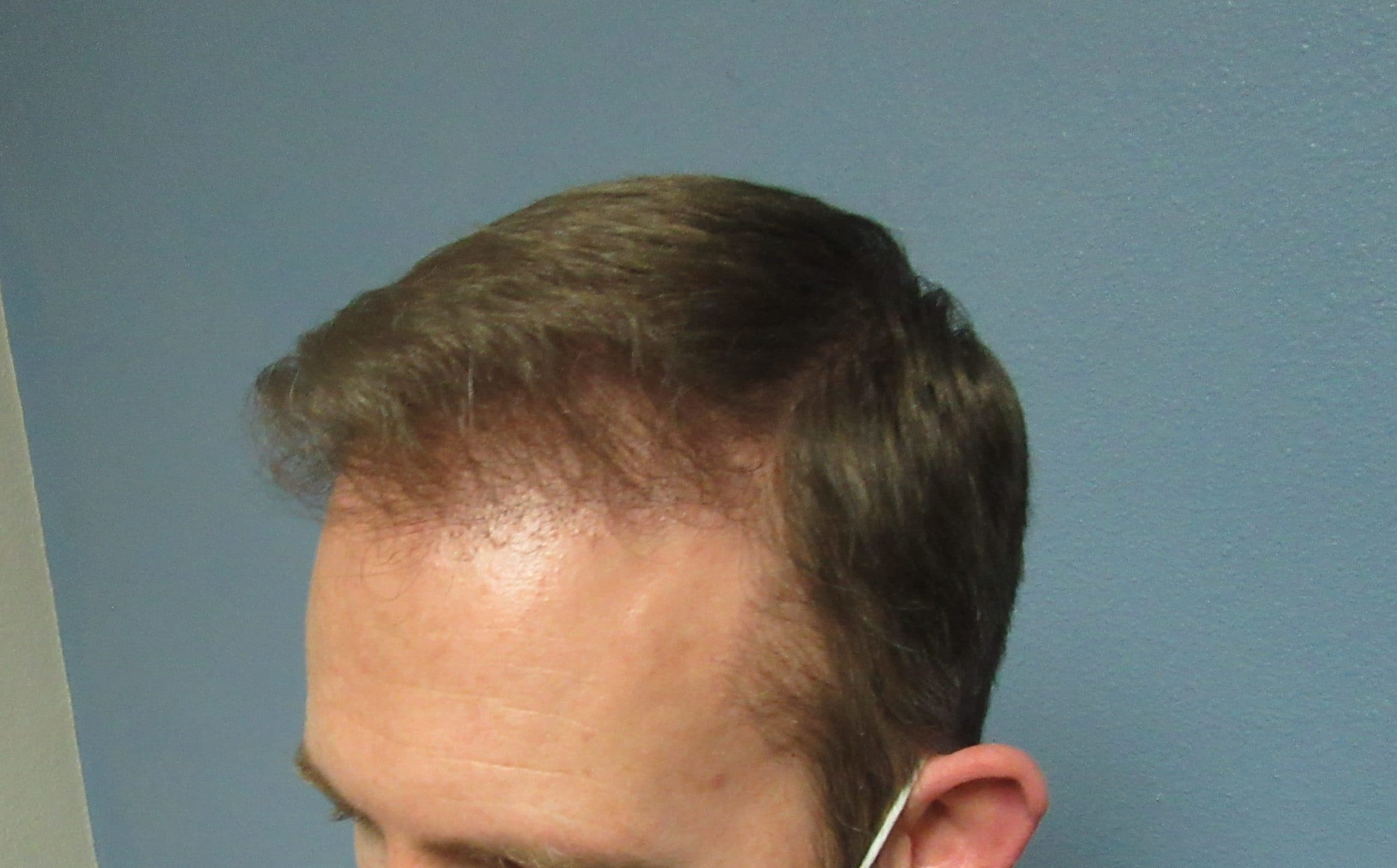 Hair Transplants Scalp Case Hair Restoration Center Of Utah