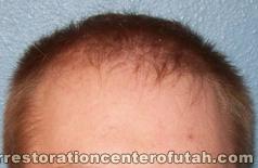 Hair Transplant (Restoration) – Case 12