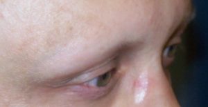 Hair Transplants (Eyebrow) – Case 2