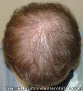 Hair Transplant (Restoration) – Case 28