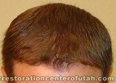 Hair Transplant (Restoration) – Case 27