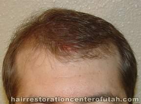 Hair Transplant (Restoration) – Case 26
