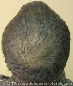 Hair Transplant (Restoration) – Case 25
