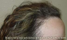Hair Transplant (Restoration) – Case 24
