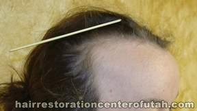 Hair Transplant (Restoration) – Case 24
