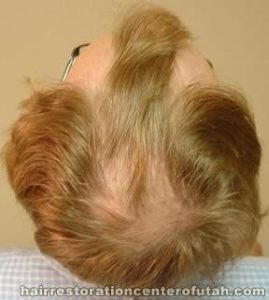Hair Transplant (Restoration) – Case 22