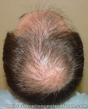 Hair Transplant (Restoration) – Case 19