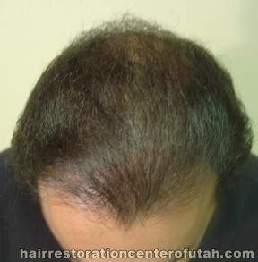 Hair Transplant (Restoration) – Case 18