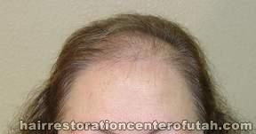 Hair Transplant (Restoration) – Case 17
