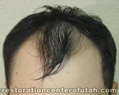 Hair Transplant (Restoration) – Case 14