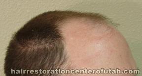 Hair Transplants (Scalp) – Case 6