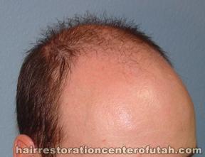 Hair Transplant (Restoration) – Case 13