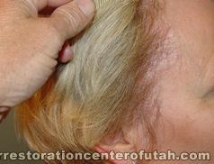 Hair Transplant (Restoration) – Case 11