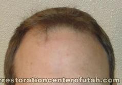 Hair Transplants (Scalp) – Case 3