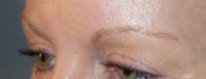 Hair Transplants (Eyebrow) – Case 1