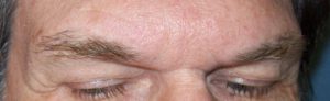 Hair Transplants (Eyebrow) – Case 3
