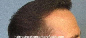 Hair Transplant (Restoration) – Case