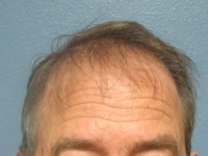 Hair Transplant (Restoration) – Case 34