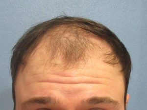 Before After Case Studies Hair Restoration Center Of Utah