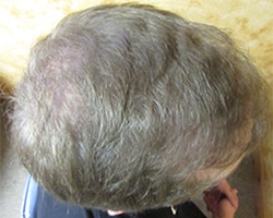 Hair Transplant (Restoration) – Case 33