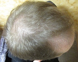 Hair Transplant (Restoration) – Case 33