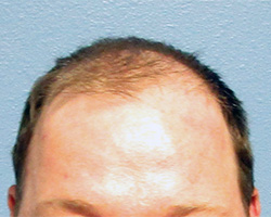 Hair Transplant (Restoration) – Case 32