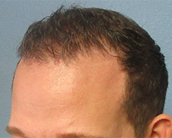 Hair Transplant (Restoration) – Case 31