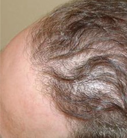 Hair Transplant (Restoration) – Case 7
