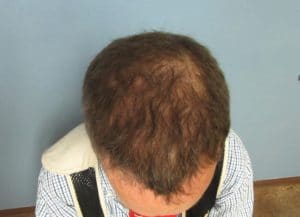 Hair Transplant (Restoration) – Case 29