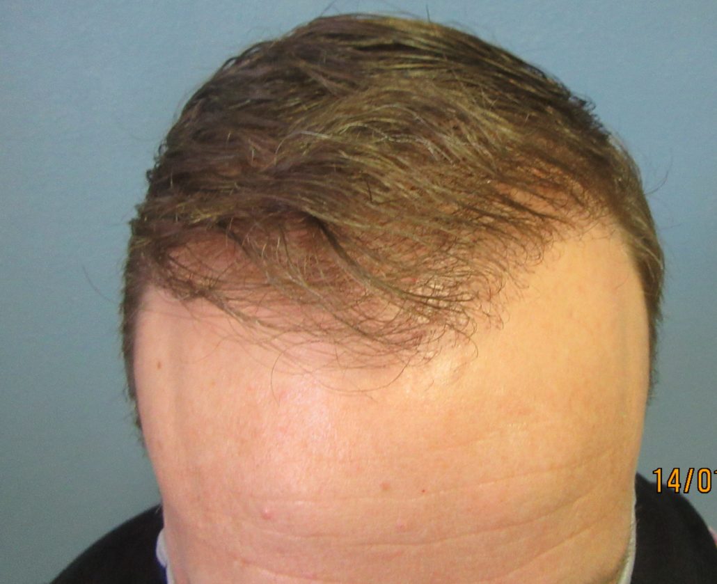 Men’s Hair Loss Hair Restoration Center of Utah